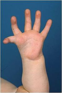 hypoplastic thumb treatment Porn view com